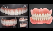 Diş için implant mı, protez mi tercih edilmeli?
