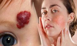 Gül Lekesi ( Hemojen ) Hastalığı Nedir? Nasıl Geçer?