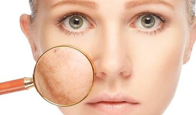 Cildiniz ışıl ışıl parlayacak! Cilt lekelerine son veren 7 doğal çözüm