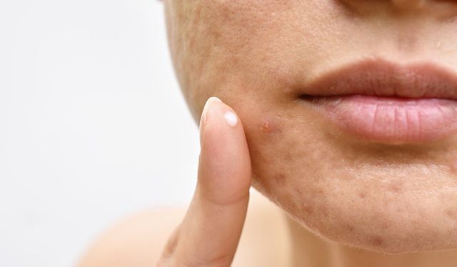 Dünya'da bir ilk: Sivilce aşısı geliştiriliyor