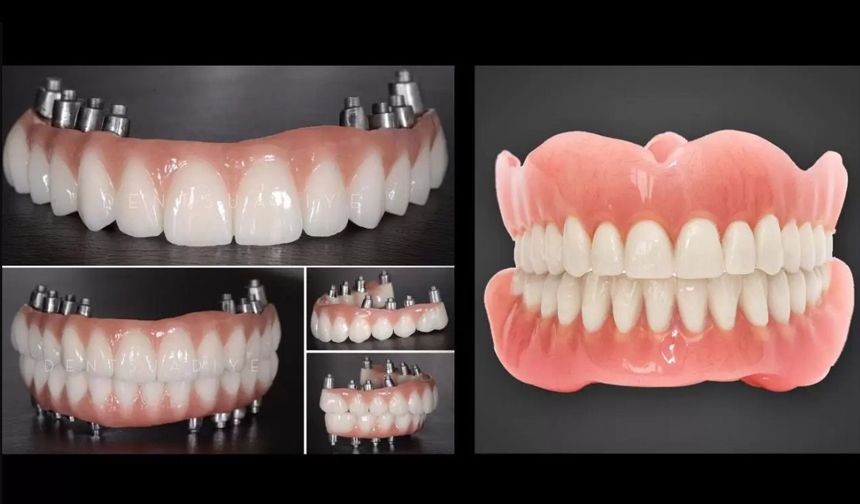 Diş için implant mı, protez mi tercih edilmeli?