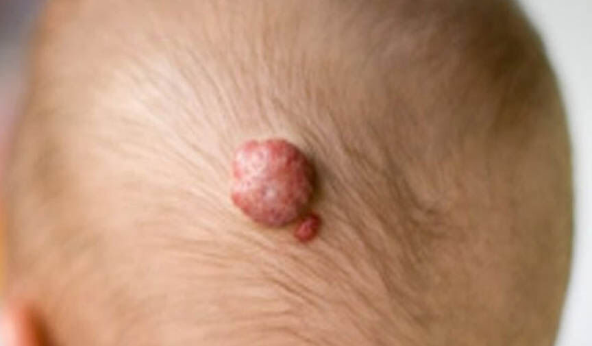 çocuklarda gül  hemojen hastalığı nasıl geçer